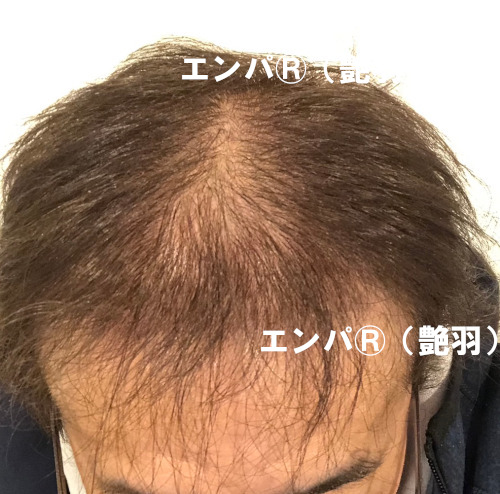 湯シャンで頭皮回復！脱毛症改善？エンパその効果！育毛ニュース