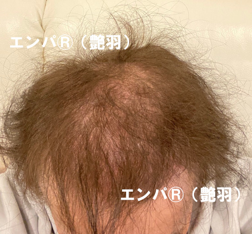 湯シャンで頭皮回復！脱毛症改善？エンパその効果！育毛ニュース