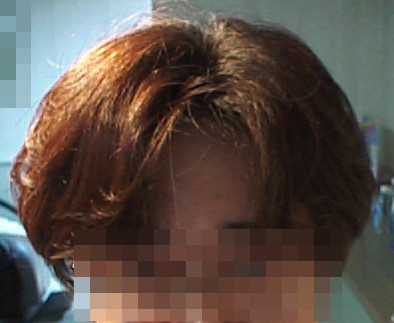 湯シャンで頭皮回復！脱毛症改善？エンパその効果！育毛ニュース